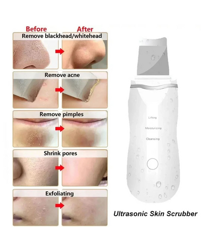Limpiador Facial Ultrasonico